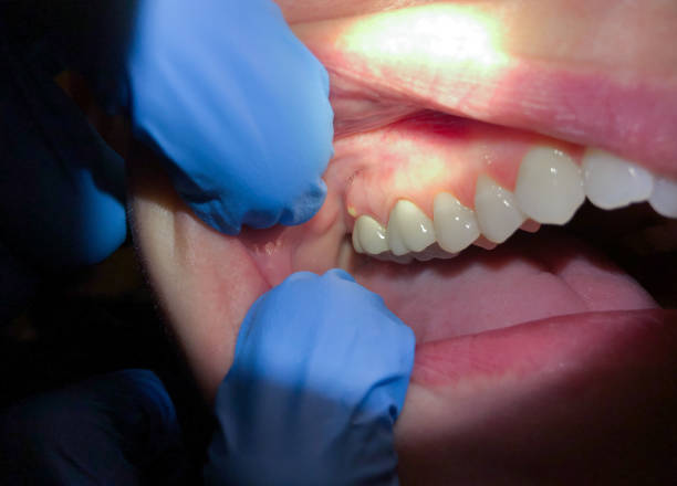 Best Emergency Dentist for Lost Fillings or Crowns in Lincolnwood, IL