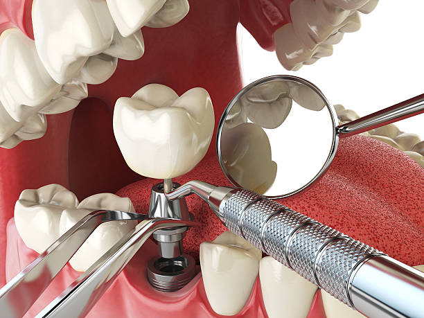Best Broken or Cracked Tooth Emergency Dentist in Lincolnwood, IL